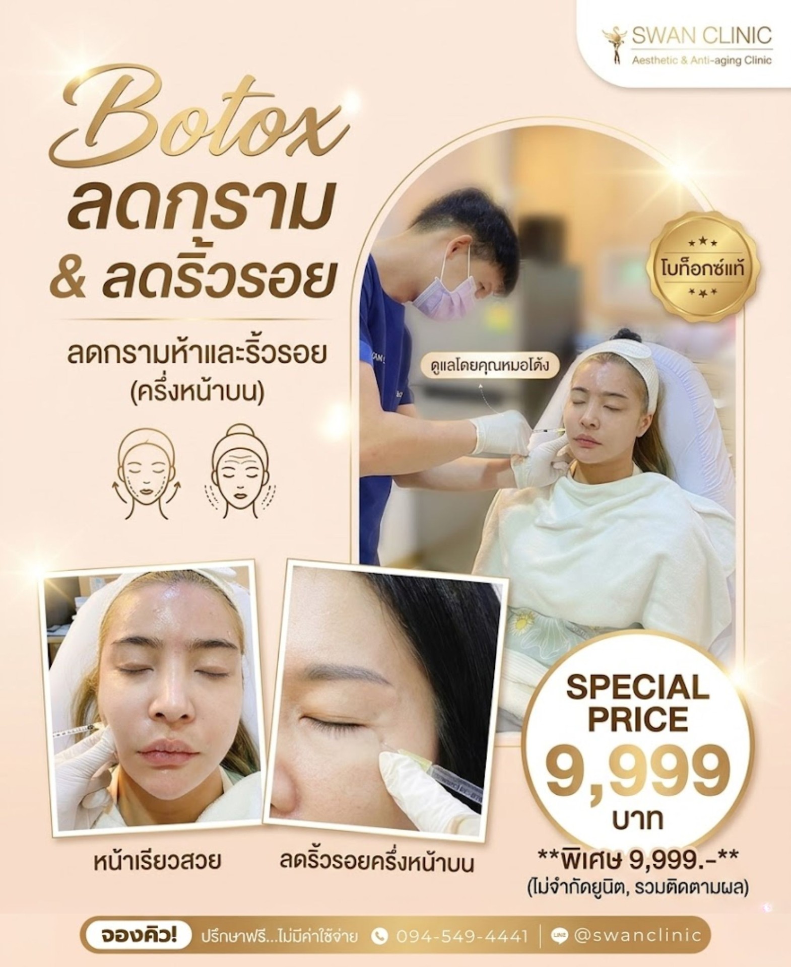 Botox ลดกราม & ลดริ้วรอย